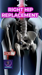 Right Hip Replacement #RightHipReplacement #HipSurgery #JointReplacement #OrthopedicCare #MobilityRecovery #PelvisImplant #PainRelief #MedicalInnovation #HealthyJoints #Orthopedics | Medical Animation Media