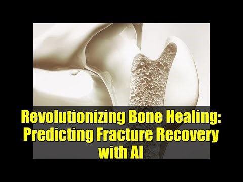 Revolutionizing Bone Healing: Predicting Fracture Recovery with AI