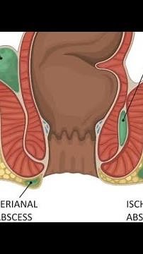 perianal abscess | abscess | incision and drainage |#dr #doctor