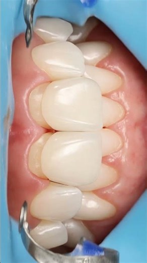 Veneers Installation Explained in 30 Seconds