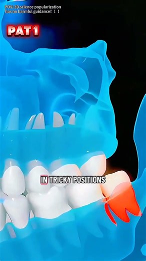 How to Tooth Extraction Process (3D Animation)#toothextraction#toothextractionsurgery