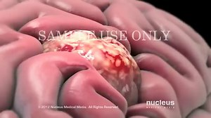 Chemotherapy vs Radiation Therapy