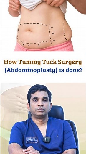 How Tummy Tuck Surgery | Abdominoplasty Procedure Step by Step | Dr. Sasikanth