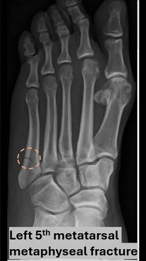 Jones fracture of the 5th metatarsal base metaphysis