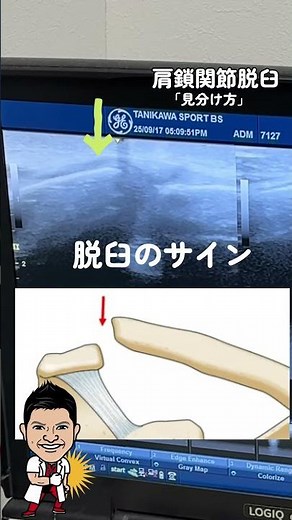 鎖骨が浮いている（肩鎖関節の脱臼）「見分け方」