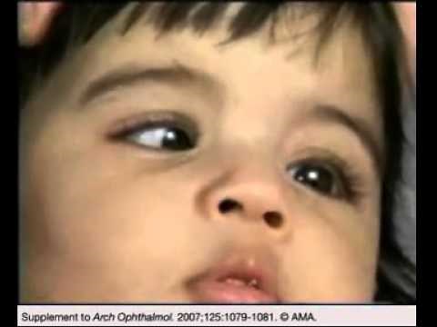 Infantile Esotropia With Nystagmus: A Treatable Cause of Oscillatory Head Movements in Children