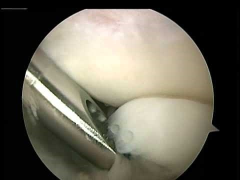Elbow arthroscopy for arthritis, bone spurs and loose bodies