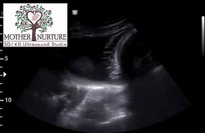 Did you know we can tell you if you baby has hair! This 37 week little girl has a full head of really long hair. Watch it move in the amniotic fluid as we tap on mom's belly! | Mother Nurture Ultrasound