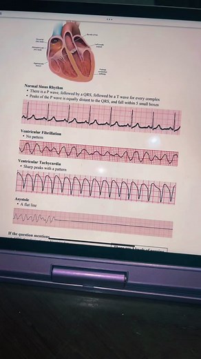 Mastering EKG Readings: Essential Tips for Nursing Students