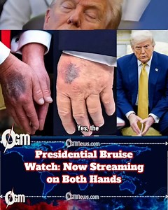 788K views · 5.1K reactions | Bilateral Bruising: Trump’s Hands Go Bipartisan For months, it was a right-hand issue. Now the left hand has joined the chat. Analysts confirm the bruise is the most consistent thing in American governance right now. Officials insist it’s harmless. The public insists on zooming in anyway. Democracy lives on — slightly purple. #CodeBlueInAmerica #OGMNews #BruiseGate #USPolitics #NewsWithHumor | OGM News | Facebook