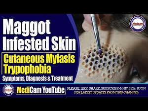 Maggot Infested Skin | Cutaneous Myiasis And Trypophobia | Diagnosis And Treatment | Medicam YouTube