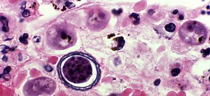 Killer Brain-Eating Amoeba Are Lurking In Lakes, Rivers Across US; Disease With 97% Fatality Rate Doesn't Have Dedicated Medical Treatment