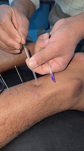 Flexor hallucis longus muscle problem acupuncture treatment #acupressuretherapy #acupuncture #acupunturatherapy #flexorhallucis #longusmuscle | Sarwan Ram Uginiya