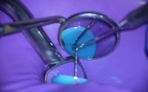 Live Root Canal Treatment -Premolar Retreatment-