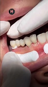 Fixed Bridge #medical #dentist #dentalartistry #dentaltreatment #satisfying