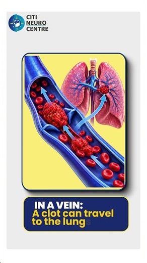 A blood clot can become a life-threatening emergency when it blocks blood flow to vital organs. 🩸