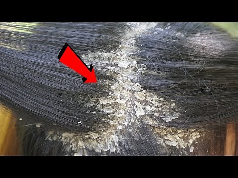 Satisfying Extremely Damaged Dandruff Removal #891