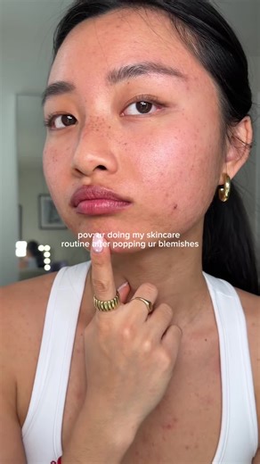 Easy 2-Step Acne Treatment for Clear Skin