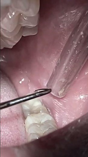 impaction of food in deep tooth cavity #viralshorts
