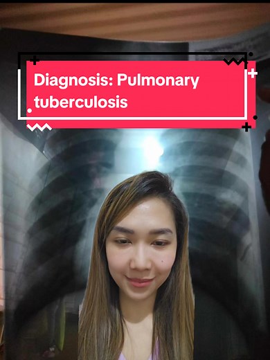 Pagsusuri at Paggamot ng Tuberculosis: Ano ang Dapat Malaman