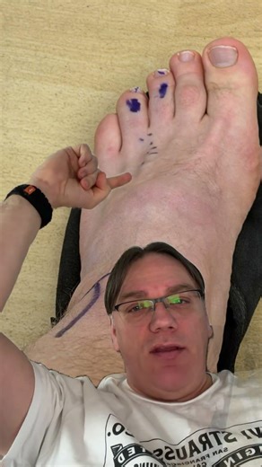 Why I haven’t run in a year: Morton’s Neuroma 🦶#shorts #ironman