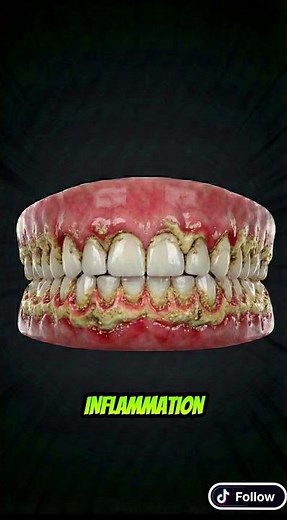 How Tartar Forms (Plaque → Calculus) + Why You Can’t Brush It Off | Dental Animation #anatomy