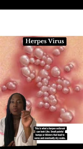 Herpes Outbreak: Symptoms, Prevention, & Treatment