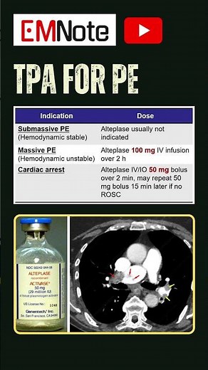 TPA for Pulmonary Embolism #doctor #medical