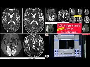 How To Convert ADC (Apparent diffusion coefficient) From (DWI) Diffusion-weighted imaging || #mri