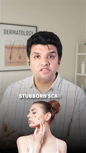 Erase Acne Scars with Surgery!