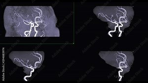 MRA Brain or Magnetic resonance angiography (MRA) of Vessel in the brain turn around on the screen. MRA Brain MIP view for evaluate cerebral artery.