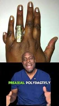 What Is Polydactyly?