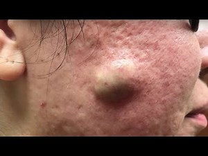 Biggest Pimple Pop Ups In The World - How To Pop Pimples