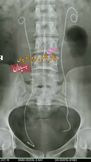 { kidney $ pcnl & Laparoscopic *surgery }