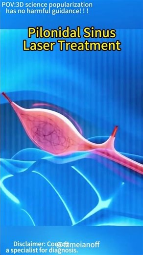 Pilonidal Cyst Treatment!! (3D Animation) #cyst#hair #3danimation#LearnOnTikTok#HealthTips