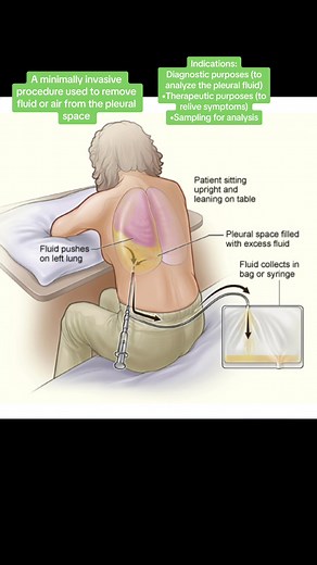 Are you familiar with this procedure? #nursingreview #nclexreview #thoracentesis #medsurgreview #medsurgnotes #nursingnotebooks