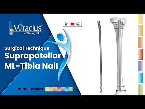 Suprapatellar ML Tibia Nail Surgical Technique