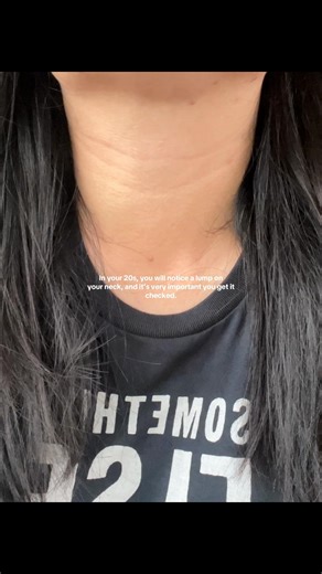 Papillary Thyroid Carcinoma: Lump Detection in Your 20s