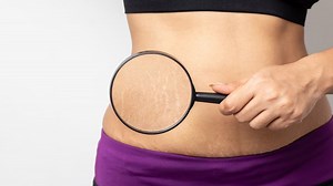 वजन बढ़ने और घटने पर स्ट्रेच मार्क पड़ने के कारण, जानें कैसे पाएं छुटकारा