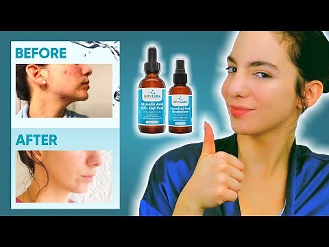 Eliminate Acne Scars with (at home) Glycolic Acid 50% Gel Peel