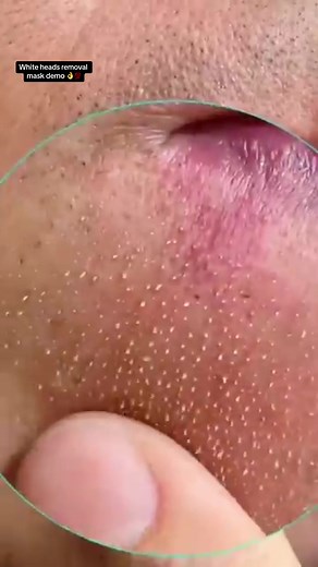 Effective Whiteheads Removal Mask Demo | Skincare Routine