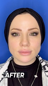 ✅ Lip Flip Botox contour ✅ Botox ( Forhead Around eyes) ✅ Chin Filler ✅ Under Eye Filler ✅ Derma Pen Dr. Hadeel 📍Abu Dhabi 📞0097126666988 #dermatology #filler #botox #chinfiller #undereye #beauty #clinica #clinic #glowingskin #skincare #exosomes #lipflip #antiage #antiageing #healthyskin #healthyskincare | Clinica Joelle