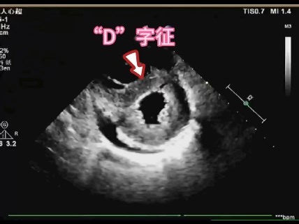 超声之“D”字征