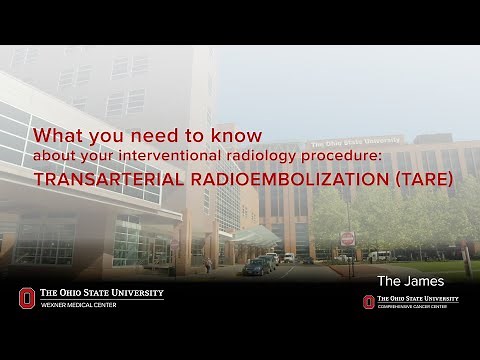 TARE: transarterial radioembolization | Ohio State Medical Center