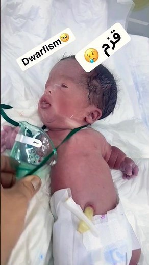 Dwarfism in Newborn: Early Diagnosis and Care in NICU.