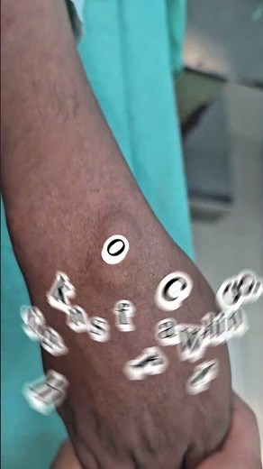 Ganglion cyst wrist