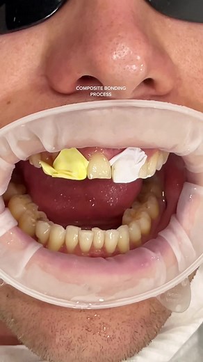 Dental Composite Bonding Procedure Explained