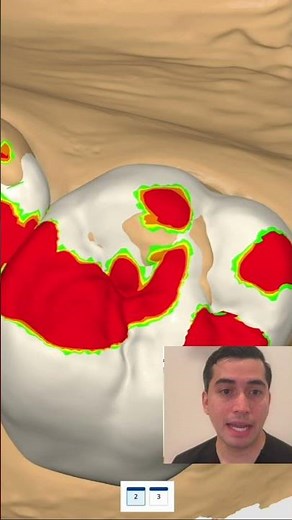 Simple workflow of inlay design with Medit ClinicCAD