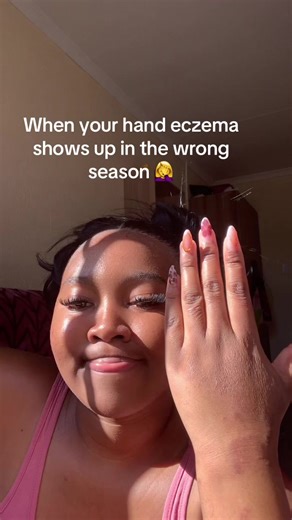 Hand Eczema Awareness: Tips for Every Season