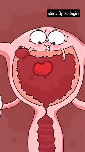 Mrs_Gynecologist on Instagram: "What Happens When….You Can’t Get Pregnant 😱🤯..!!#fypシ #2danimation #shorts #foryou #comedy #reels In this powerful 3D animation by @mrs_Gynecologist, the uterus, endometrium, and ovaries come alive to show the hidden struggle many women face. When the uterine lining grows outside the uterus, it can damage the ovaries, block egg development, and make conception difficult. 🌸 REASON: Endometriosis occurs when the endometrial tissue (the lining of the uterus) grows